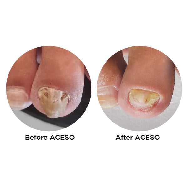 Aceso Salon sloution Nail Care Kit 