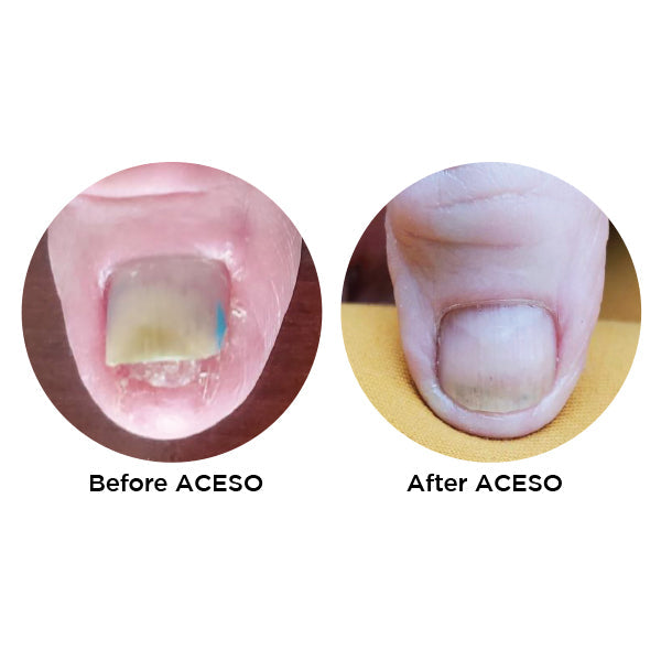 Aceso Salon sloution Nail Care Kit 